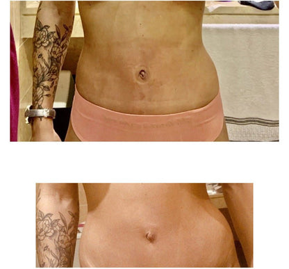 Bouchon Ombilical Conique Ou Cylindrique Remodelage Et Forme Nombril Après Abdominoplastie